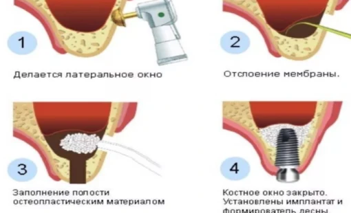 Синуслифтинг и установка имплантатов