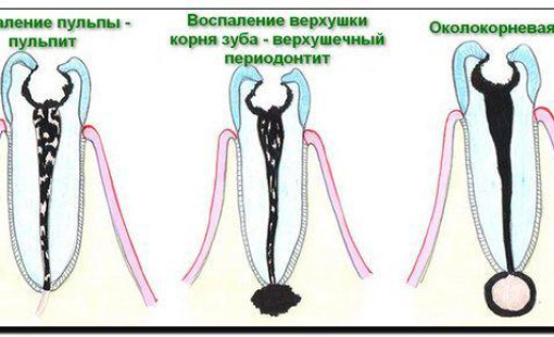 Хирургическое лечение гранулемы (кисты) зуба