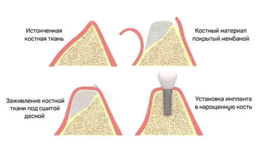 Наращивание объёма кости нижней челюсти под зубной имплант.